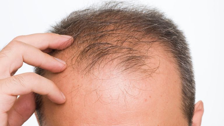Researchers Reach a Major Milestone in the Search for a Baldness Cure