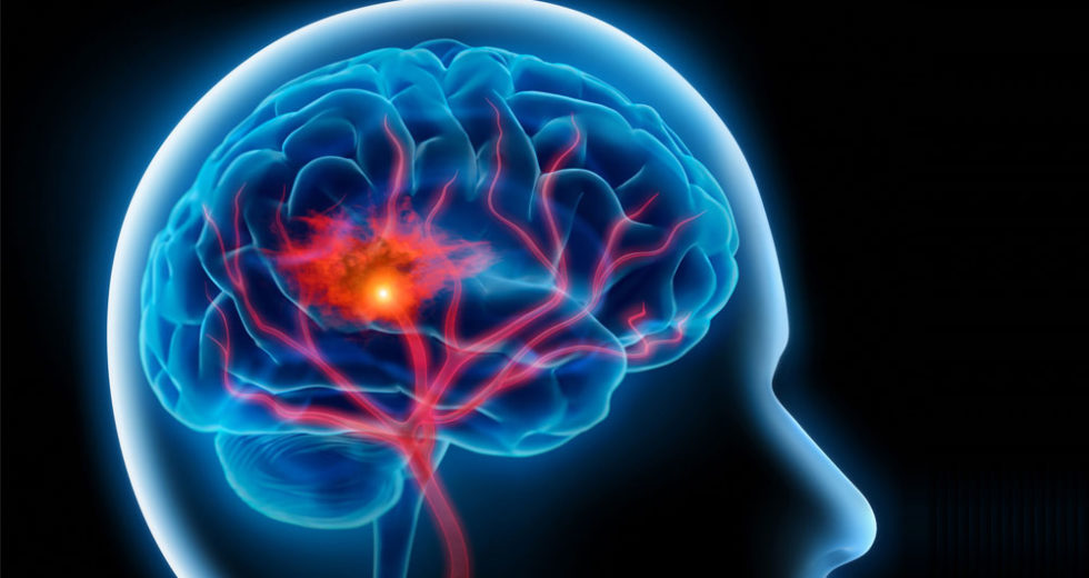 Prolonged Working Hours To Boost Risks Of Stroke