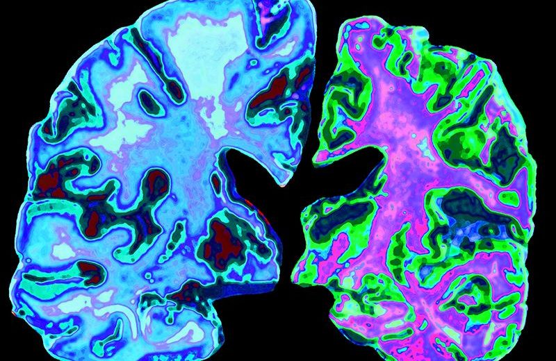 Alzheimer’s Disease Affects More Women Than Men – New Research Revealed Why