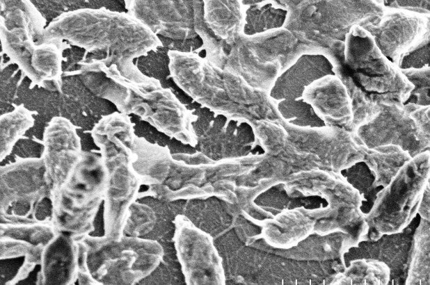 Flesh-Eating Bacteria Made Another Victim In Florida