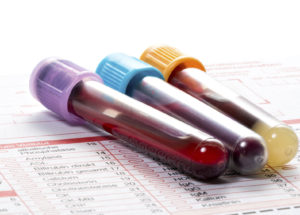 Blood Tests That Calculate A Person’s Risk Of Death Developed By Scientists