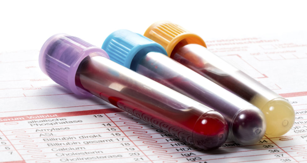 Blood Tests That Calculate A Person’s Risk Of Death Developed By Scientists