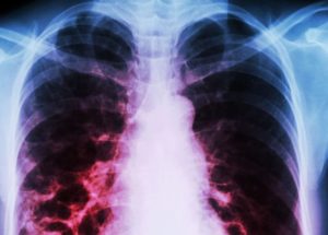 Unknown Lung Disease Caused By Vaping Found By Doctors