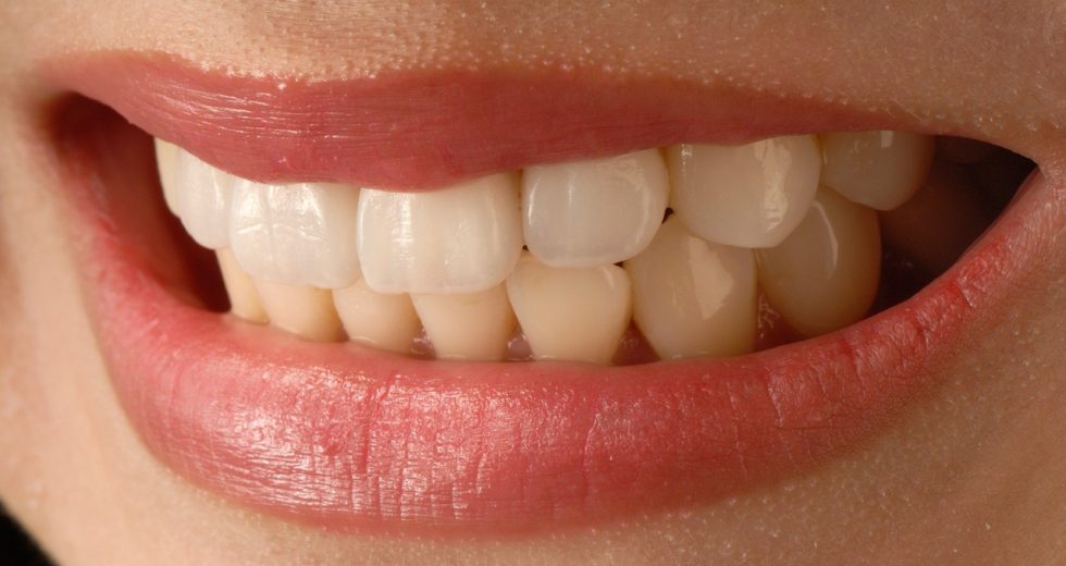 6 Things You Need to Know Before Getting Dental Veneers