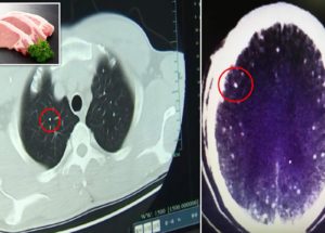 This Man Has More Than 700 Tapeworms In His Brain And Lungs Due To Uncooked Pork