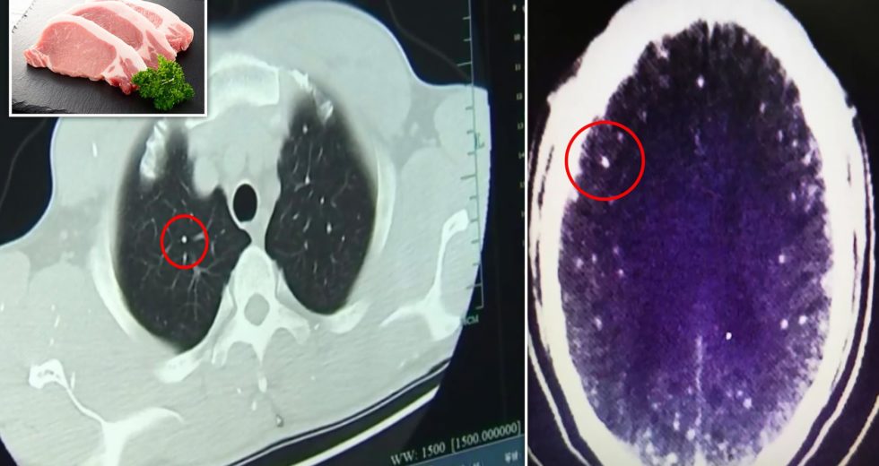 This Man Has More Than 700 Tapeworms In His Brain And Lungs Due To Uncooked Pork