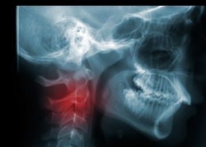 Patients Diagnosed With HPV-negative Oropharynx Cancer Face a Higher Risk of Early Death