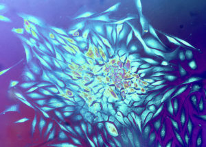 Cancer Could Be Genetically Determined Decades Before It Manifests