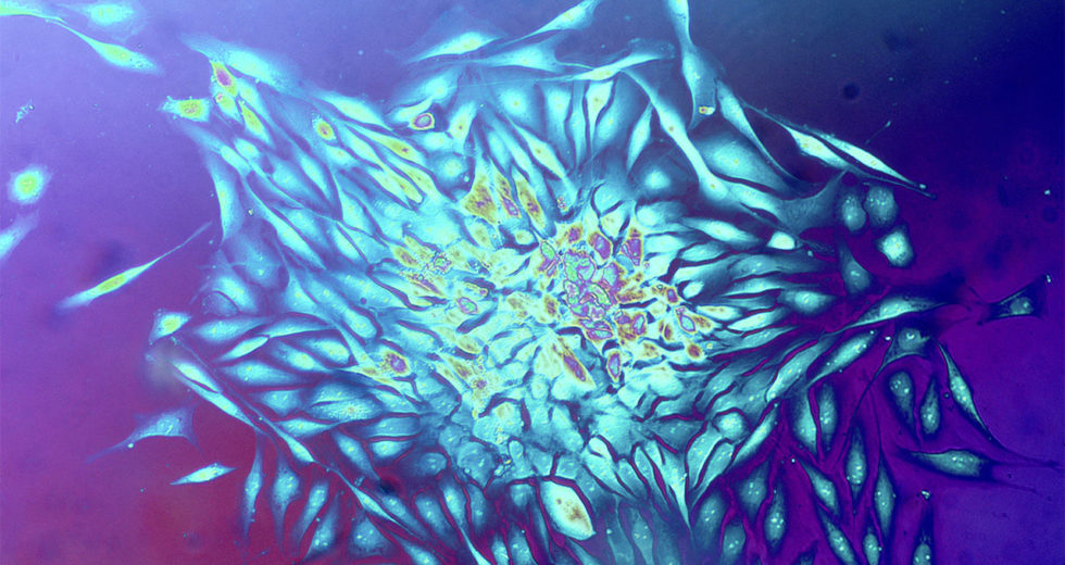 Cancer Could Be Genetically Determined Decades Before It Manifests