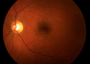 Age-related Macular Degeneration Could Get a Cure Soon