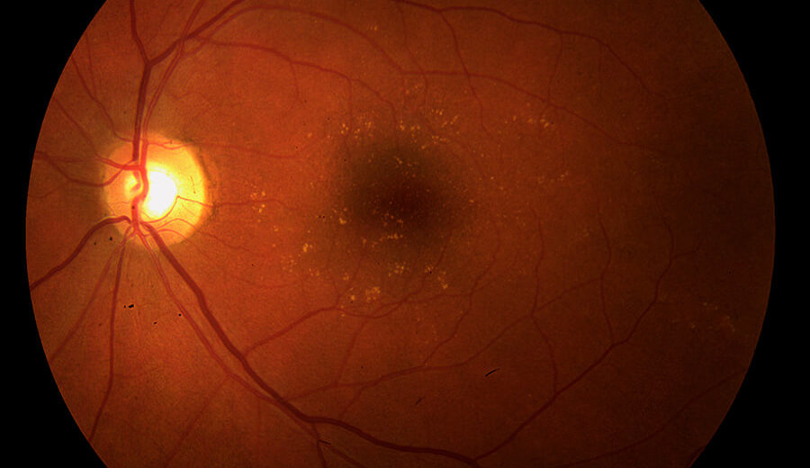 Age-related Macular Degeneration Could Get a Cure Soon