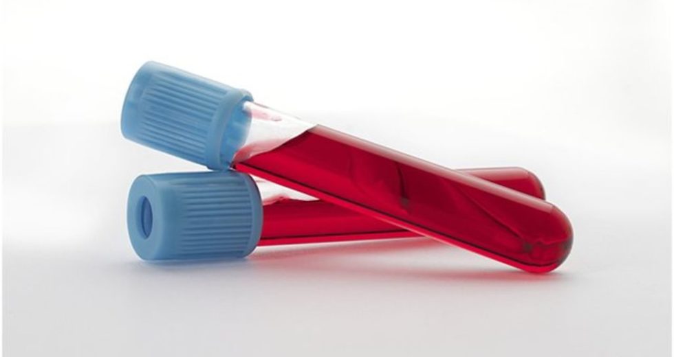 Alzheimer’s Disease Might Be Diagnosed With Just a Blood Sample, a New Study Shows