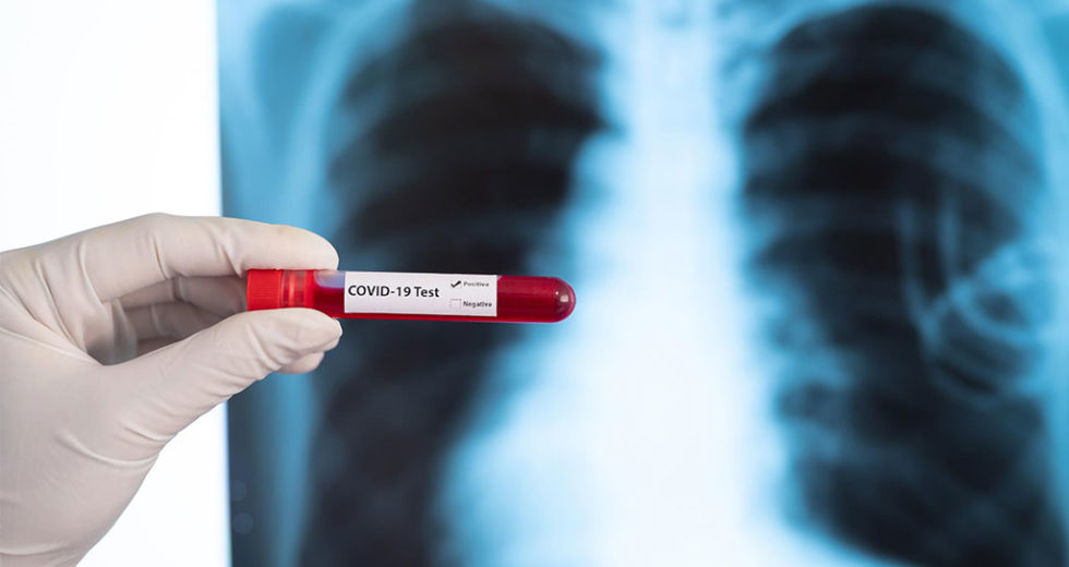 Controversial Low-Cost Treatment, Tested For Coronavirus Cure