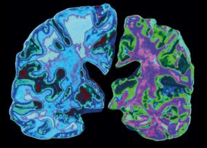 Mind-Blowing New Alzheimer Pathology Cause, Revealed – We Do This Every Day