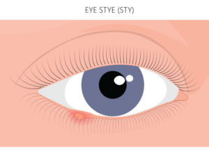 Struggling with a stye? Here’s how you can treat it at home