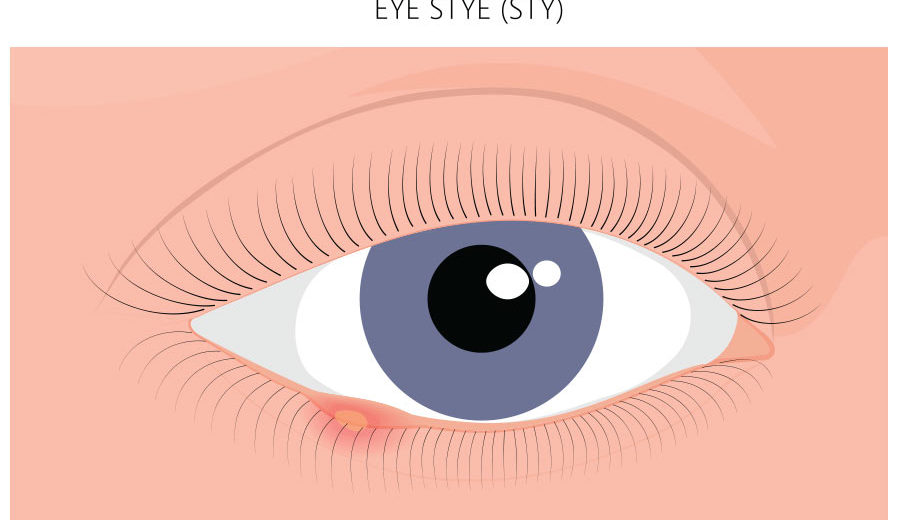 Struggling with a stye? Here’s how you can treat it at home