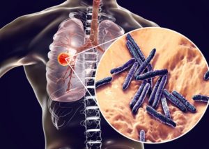 Tuberculosis Managed to Reshape the Immune Systems of Many People