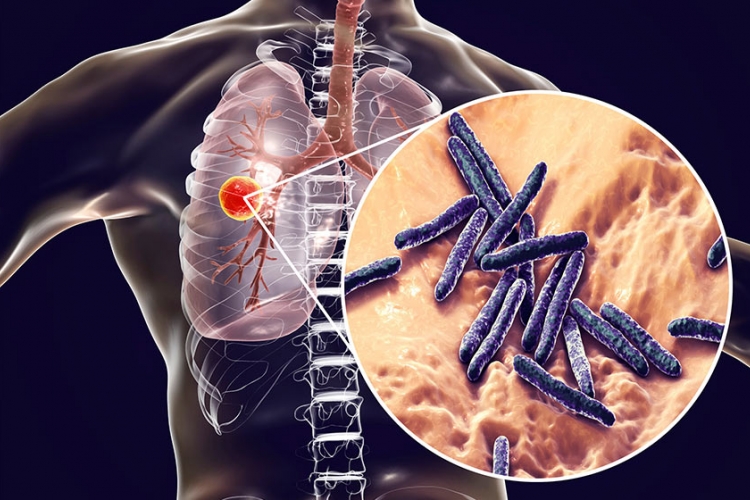 Tuberculosis Managed to Reshape the Immune Systems of Many People