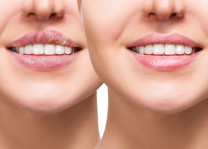 5 Things To Know About Canker