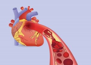 Biomechanical Model Helps Forecast Heart Attacks