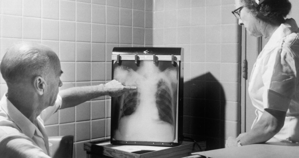 Tuberculosis Can Spread Through Breathing Just Like Coronavirus