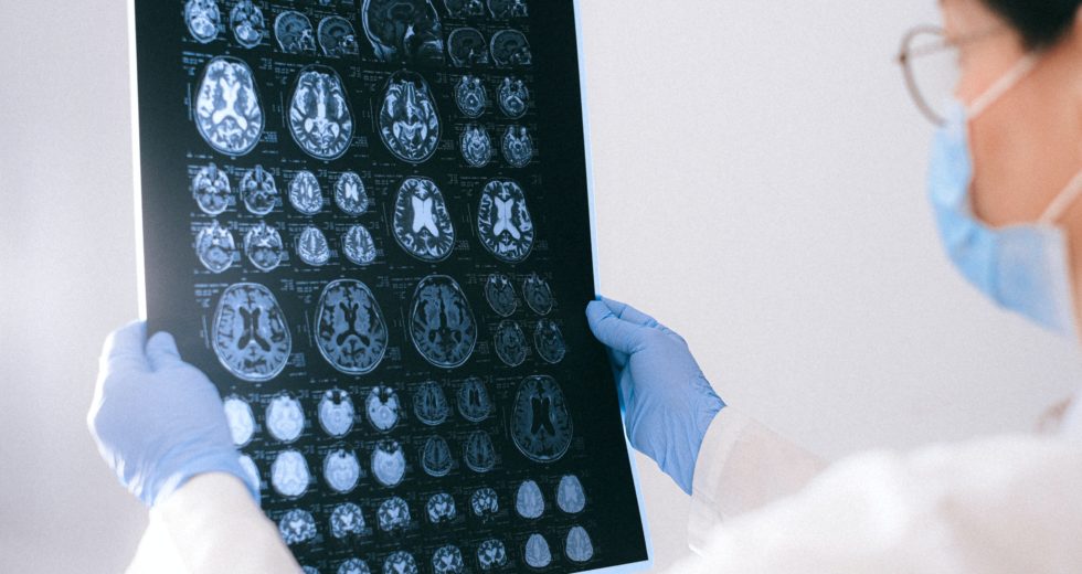 Stroke Damage Similar To That Caused By COVID-19