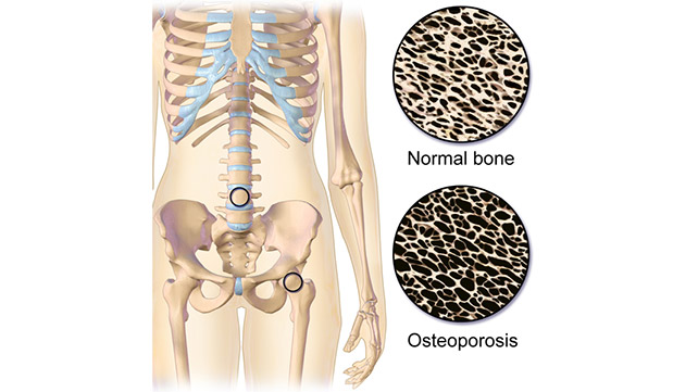 UK Specialists Issue Statement Encouraging People with Osteoporosis to Exercise