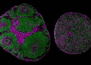 New Study Proves Autism-Linked Mutations Can Be Reversed Through Gene Therapy