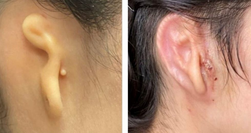The First Transplant of a 3-D Printed Body Part Was Successfully Performed