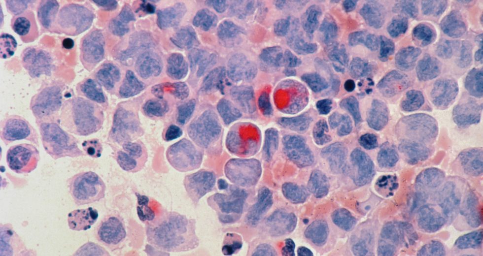 Renowned Dietary Supplements Might Increase the Risk of Cancer