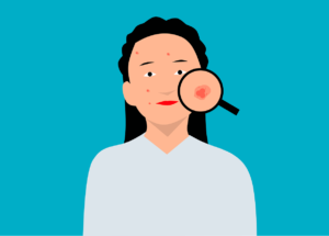 The Science Behind Acne: What Causes It and How To Treat It Effectively