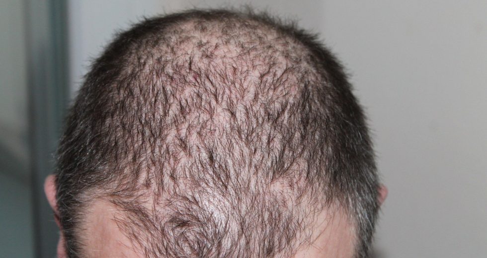 Expert Shares How to Avoid Male Hair Loss