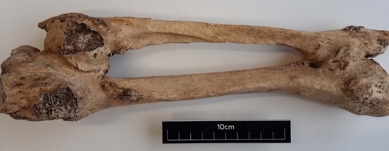 Extremely Rare Disease Coincidence Found in Medieval Graveyard