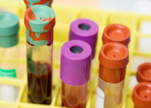 Study Finds that Blood Type Is Linked to Your Risk of Early Stroke!