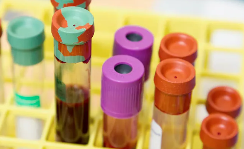 Study Finds that Blood Type Is Linked to Your Risk of Early Stroke!