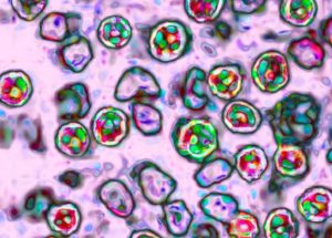 Eliminated Disease Surges Again after Decades Resulting in Tens of Unvaccinated Child Hospitalizations