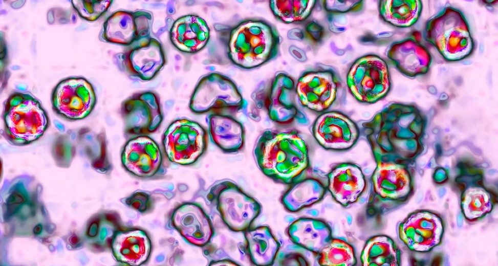 Eliminated Disease Surges Again after Decades Resulting in Tens of Unvaccinated Child Hospitalizations