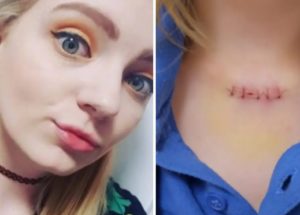 Young Woman Who Never Got Sunburned Was Diagnosed with Skin Cancer