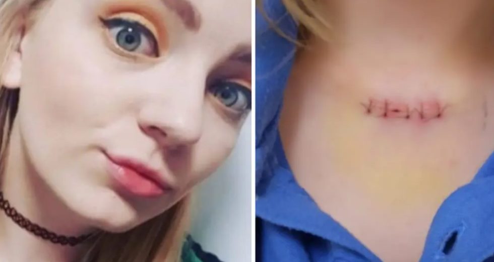 Young Woman Who Never Got Sunburned Was Diagnosed with Skin Cancer