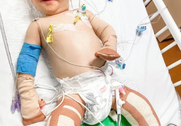 1-Year-Old Gets Legs Amputated after Contracting Scary Illness on the Rise among Children
