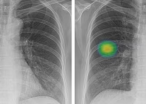 Study Finds that AI Is Twice as Good at Detecting Lung Cancer as Doctors