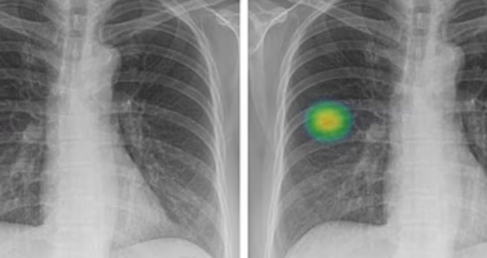 Study Finds that AI Is Twice as Good at Detecting Lung Cancer as Doctors