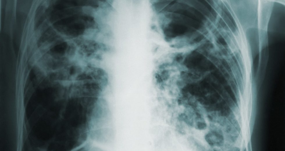Tuberculosis Patient Refuses Treatment