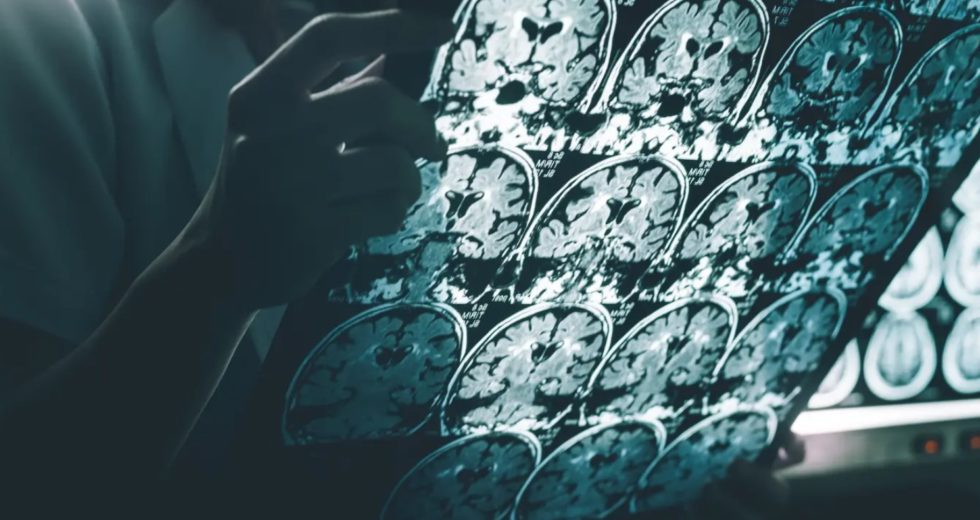 Scientists Find “Remarkable” Method of Reversing Dementia