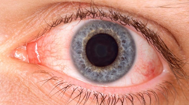 Health Officials Announce that New COVID-19 Strain Can Cause Pink Eye