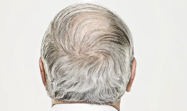 Why Does Hair Turn Grey as We Age? – Science May Finally Have the Answer!
