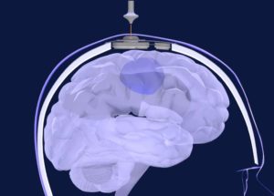 Revolutionary Chemotherapy Treatment Can Reach the Brain to Kill Tumors for the First Time Ever!
