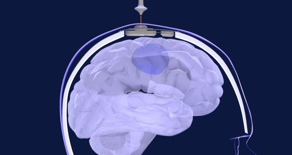 Revolutionary Chemotherapy Treatment Can Reach the Brain to Kill Tumors for the First Time Ever!