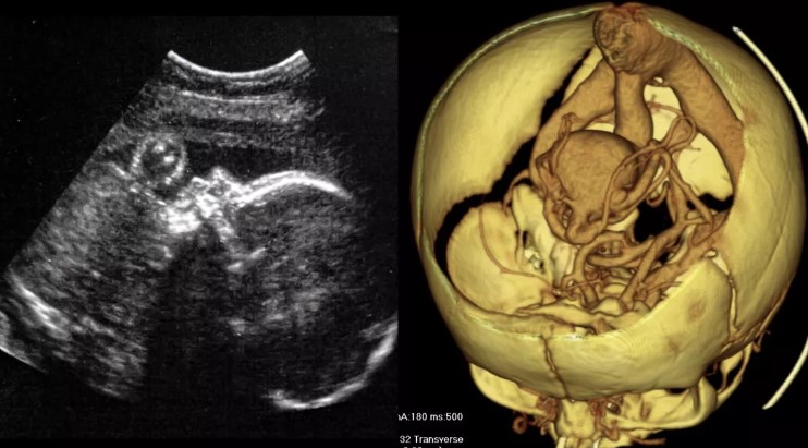 First Ever Brain Surgery on a Fetus in the Womb Successful!