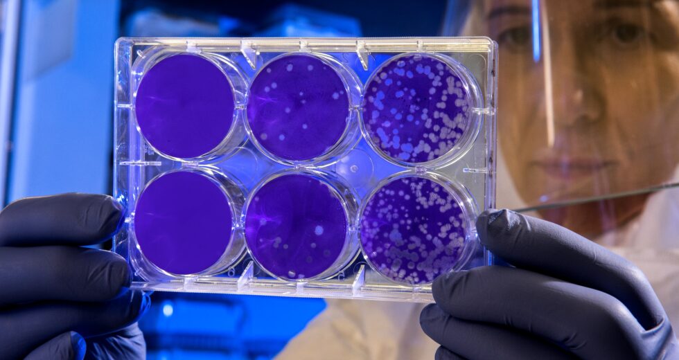 Pap Smear Indicating Epithelial Cell Abnormality – What You Need to Know